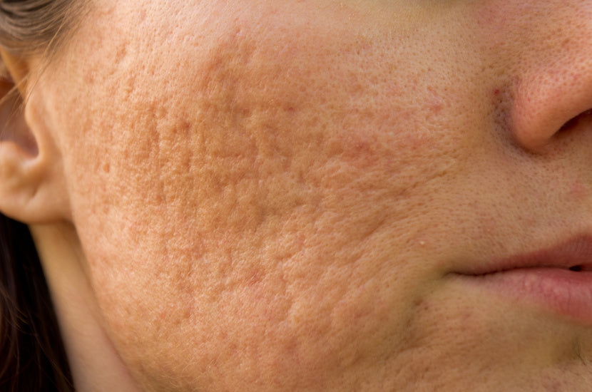 Example of boxcar scars